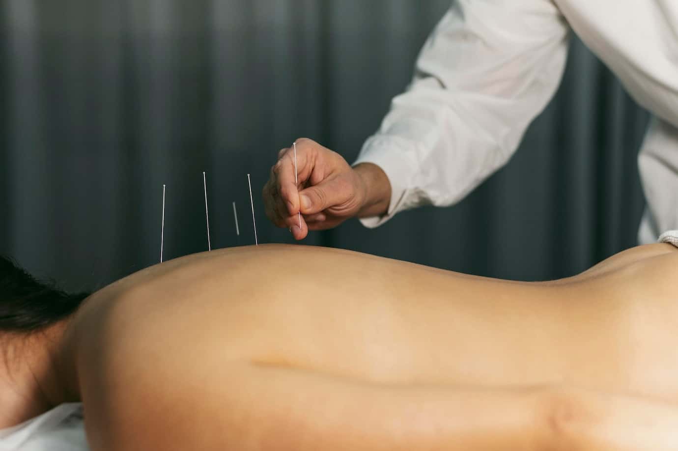 A practitioner carefully inserts acupuncture needles into the back